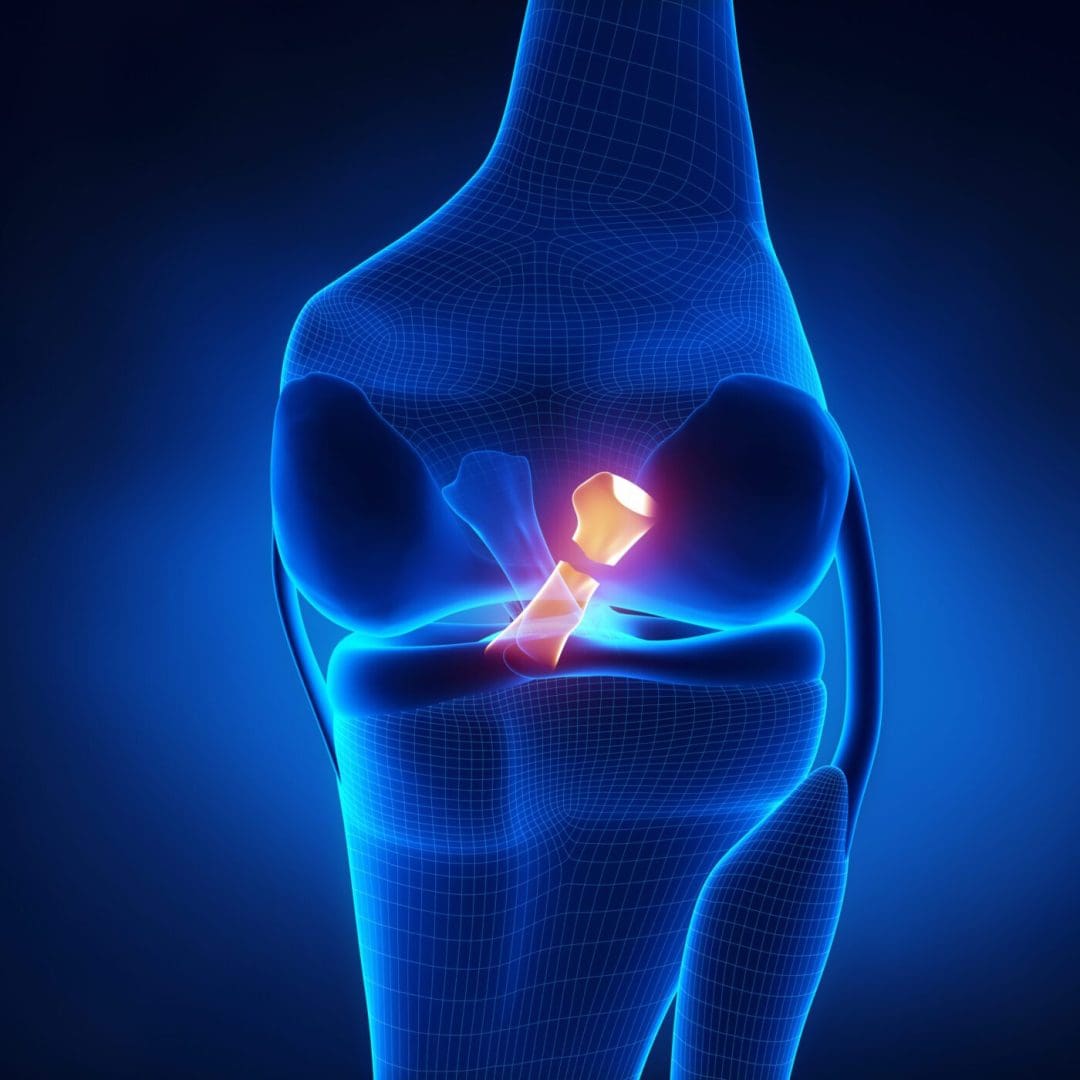 ACL Rupture - LIVEWELL Health